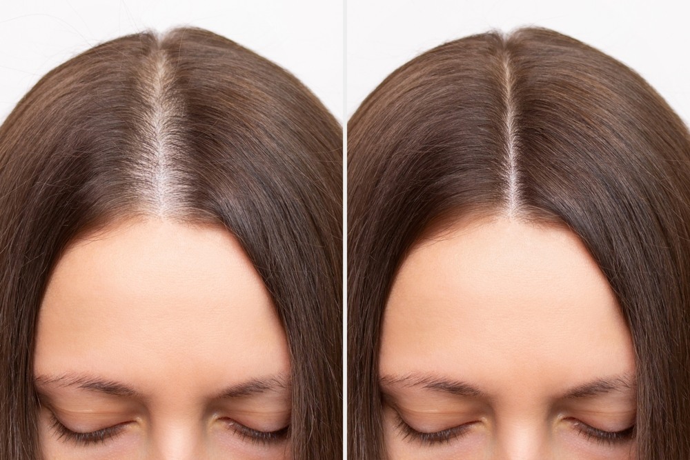 PRP Hair Therapy